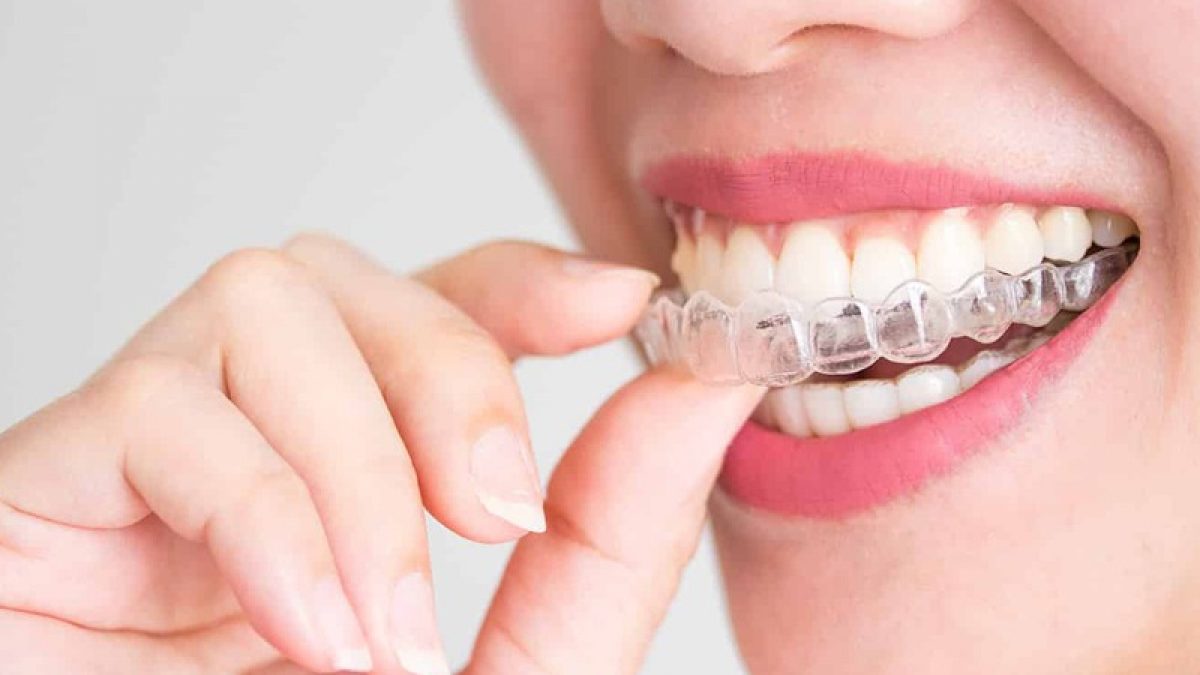 What is Invisalign? Get to know this invisible orthodontics