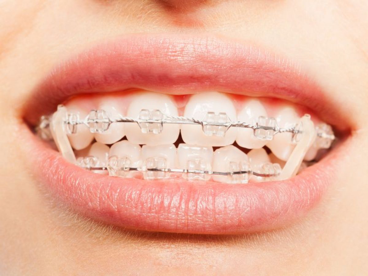 Types of Orthodontic Elastics And Why You Need to Wear Them